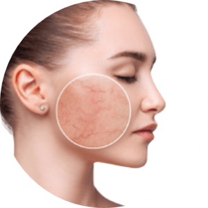 Laserowe zamykanie naczynek